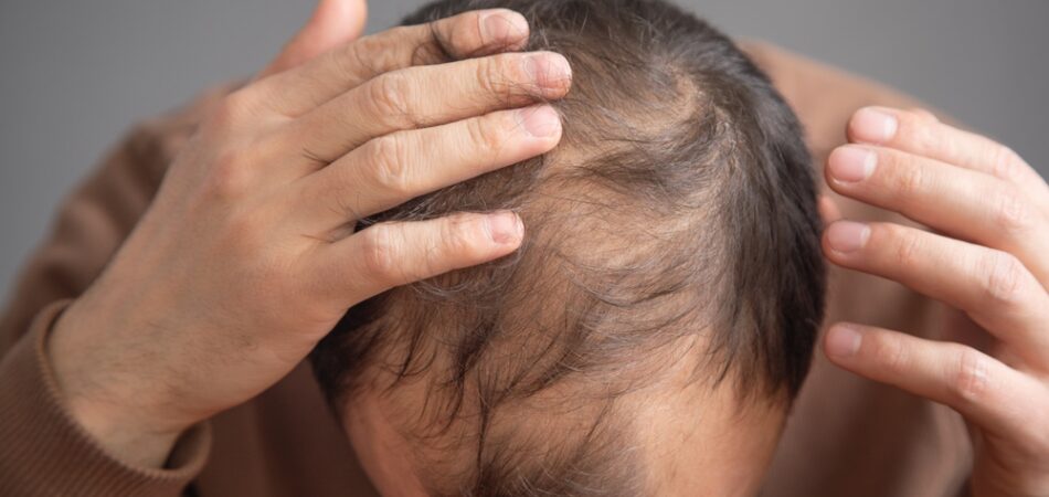 Caucasian,man.,hair,loss,problem