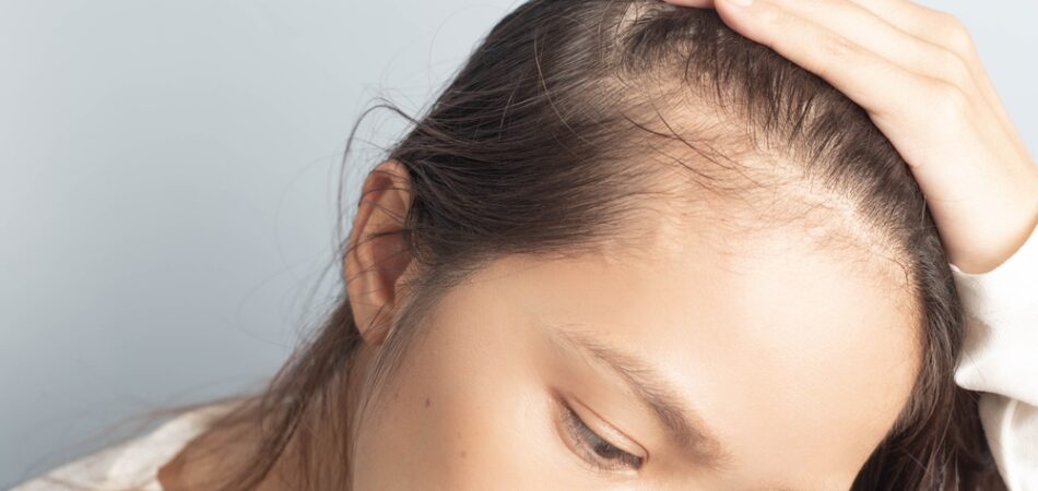 Young,women,stressed,and,having,hair,loss,,thinning,hair