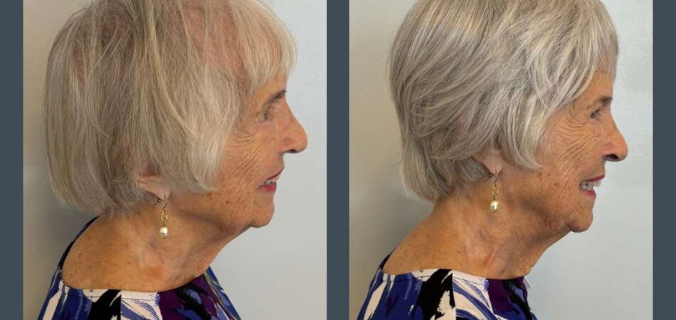 Hair Topper Naples Fl 2