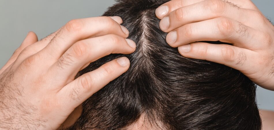 Closeup,male,dark,hair.,head,skin,problems,,receding,hairline,,alopecia,